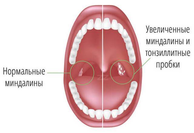Гнойная ангина у взрослых — фото, симптомы и лечение, первые признаки, профилактика