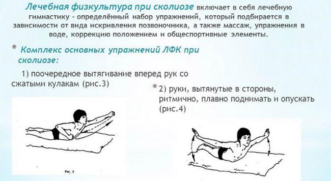 Правила и принципы выполнения упражнений при сколиозе 2 степени