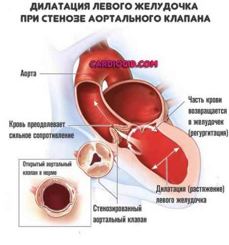 Симптомы инфаркта у мужчины: первые признаки продромальной стадии, проявления острейшей фазы и атипичных форм