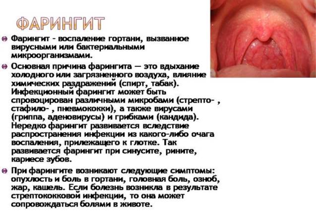 Фарингит у взрослых: симптомы, лечение, лекарства. как лечить хронический фарингит у взрослых