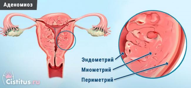Заболевания шейки матки, лечение и профилактика