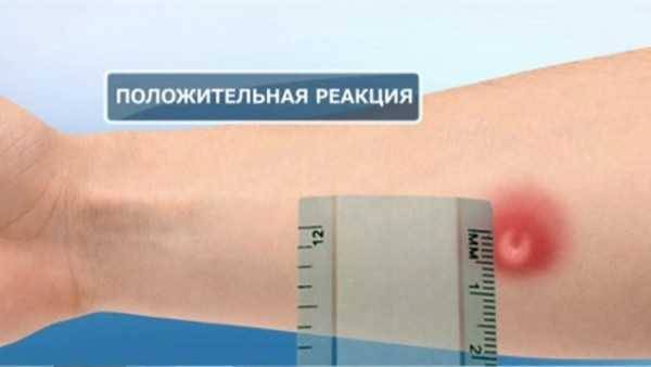 Может ли возникнуть аллергия на диаскинтест и как она проявляется?