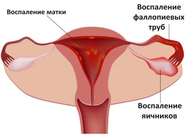 Эндометрит острый и хронический