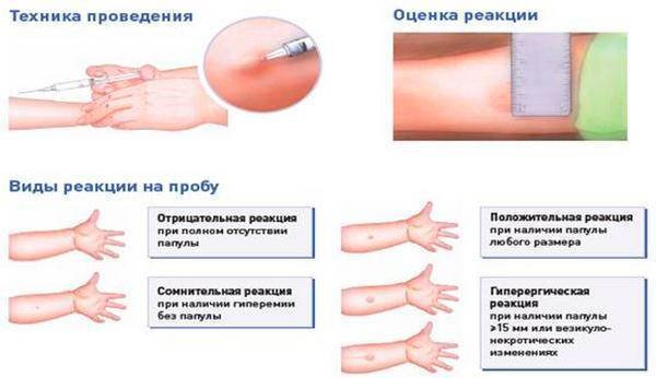 Можно ли делать диаскинтест если болит горло