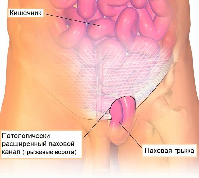 Почему возникает паховая грыжа, и нужно ли ее оперировать?