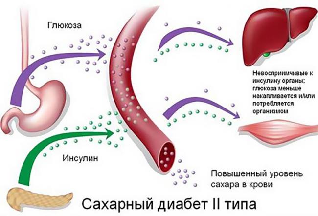 Кетоацидоз у детей