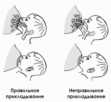 Застой молока у кормящей мамы