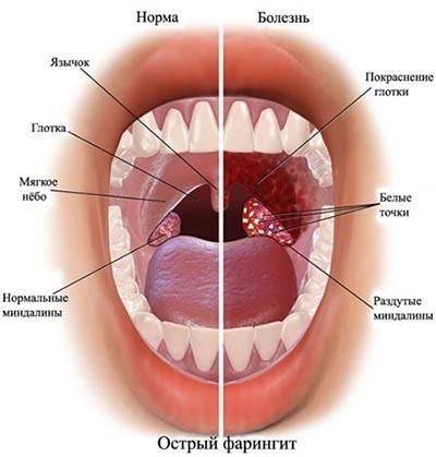 Симптомы и лечения хронического фарингита у взрослых