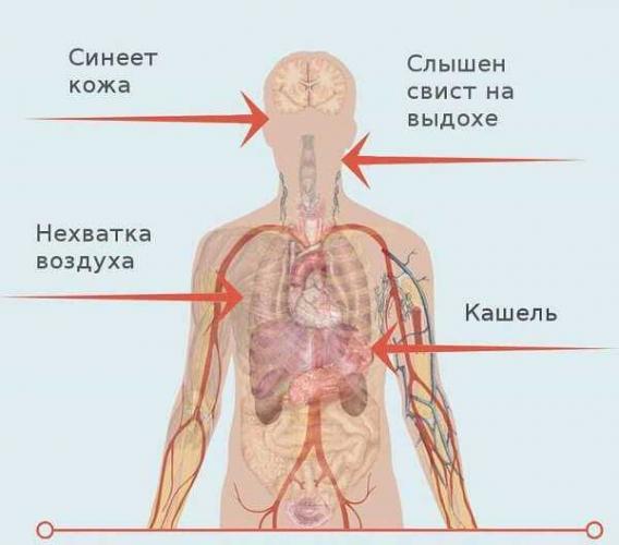 Острый бронхит и причины его возникновения