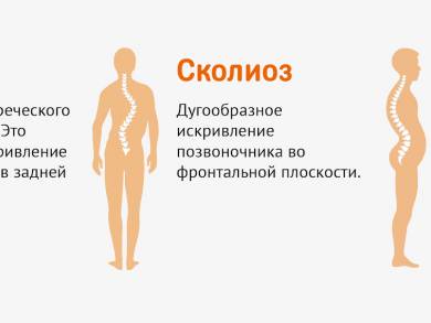 Кифоз шейного отдела позвоночника
