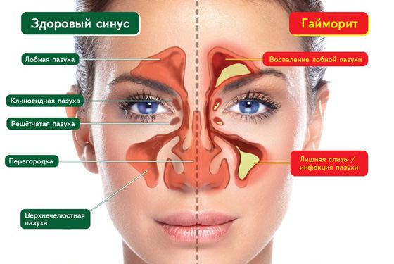 Промывание носа при гайморите