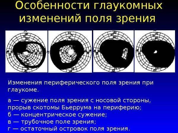 Скотома (темные пятна в поле зрения): что это такое?