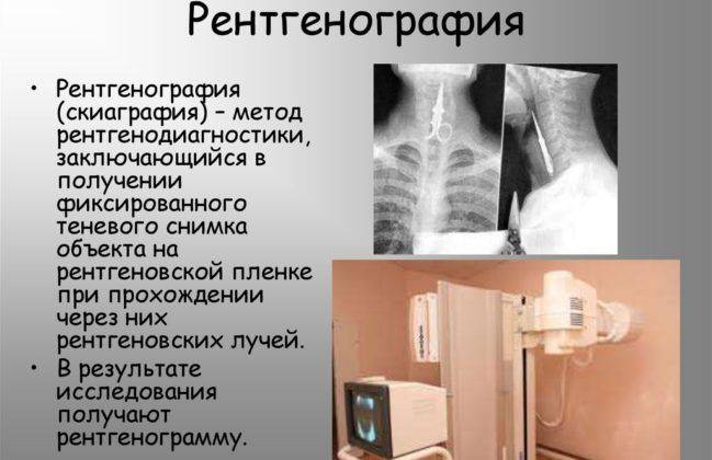 Признаки пневмонии у ребенка без температуры но с кашлем симптомы