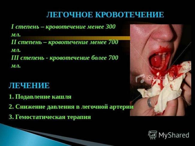 Синдром кровохарканья - причины, диагностика, методы лечения