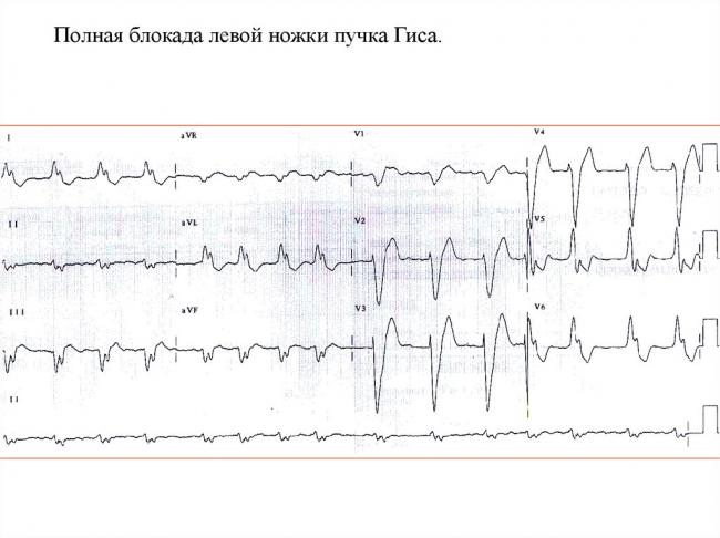 Неполная блокада левой ножки пучка гиса: причины, симптомы и лечение
