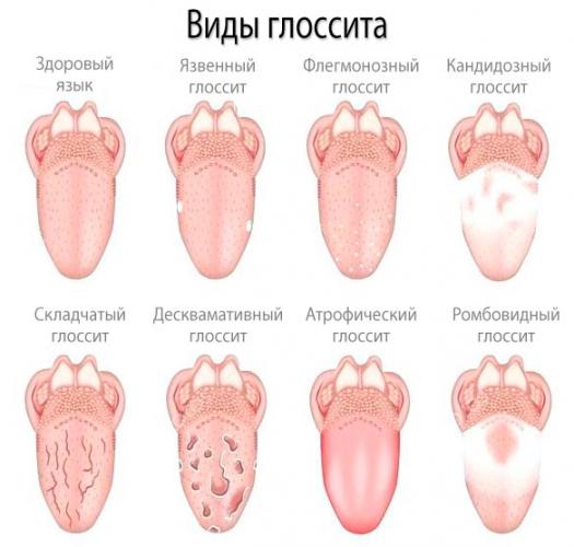 Глоссит: виды, симптомы, причины, лечение у взрослых