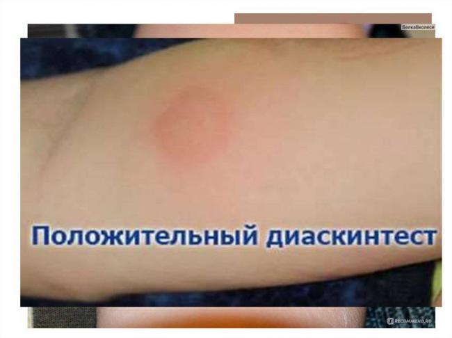 Можно ли делать диаскинтест после прививки от гриппа?