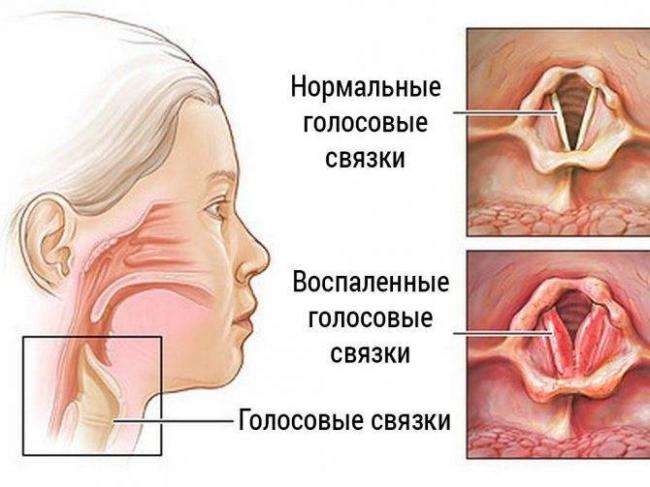Трахеит потеря голоса лечение
