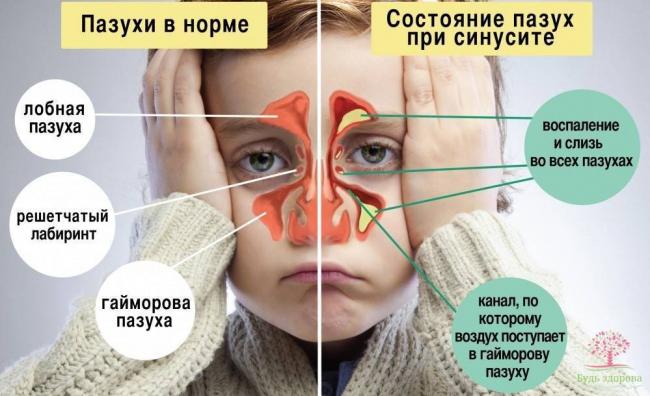 Психосоматика гайморита и синусита причины по синельникову