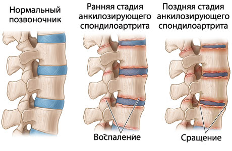Классификация спондилита позвоночника и его лечение