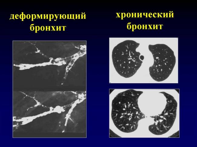 Особенности развития, течения и лечения бронхита обструктивного у взрослых