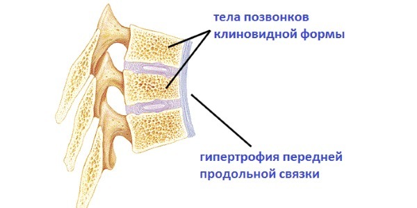 Спондилит поясничного отдела позвоночника, что это такое