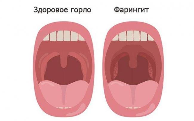 Лечение хронического фарингита у взрослых