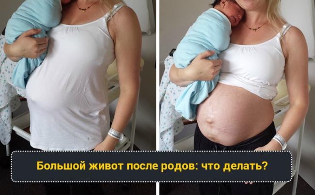 Как убрать обвисший живот после кесарева