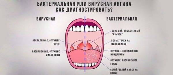 Симптомы и лечение хронического тонзиллита у взрослых