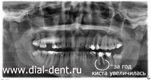 Возможно ли лечение кисты зуба без удаления