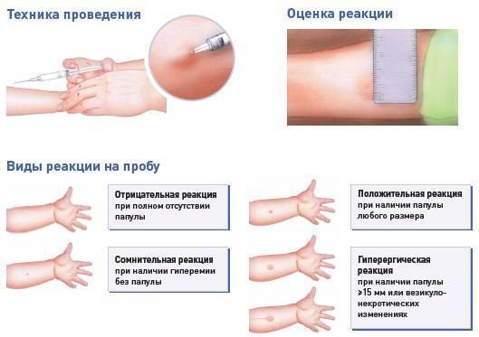 Проверка реакции манту: нормы для детей разного возраста