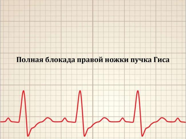 Неполная блокада левой ножки пучка гиса: причины, симптомы и лечение