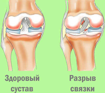 Растяжение связок коленного сустава и их лечение в клинике доктора глазкова в москве