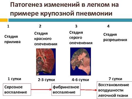 Крупозное воспаление легких: причины, симптомы, лечение