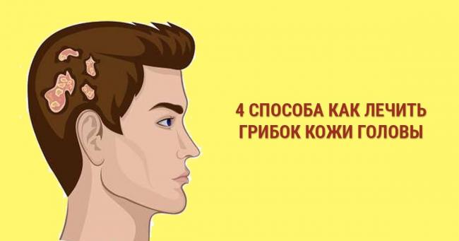 Что делать если у вас обнаружили грибок волосистой части головы