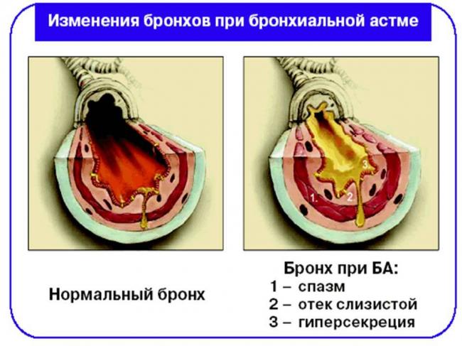 Лечение бронхиальной астмы народными средствами у взрослых и детей