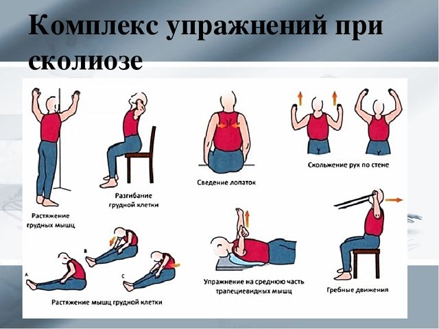 Правила и принципы выполнения упражнений при сколиозе 2 степени