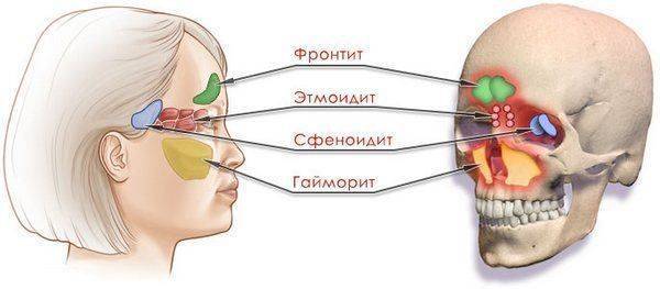 Как лечить острый и хронический сфеноидит?