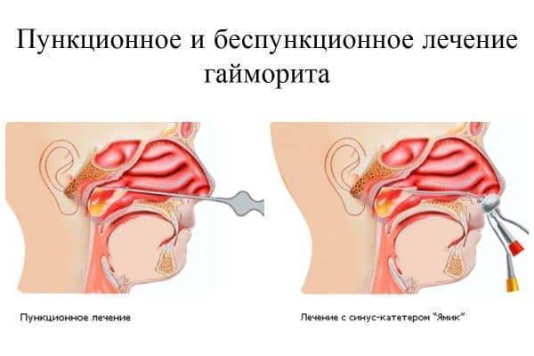 Какие антибиотики колоть при гайморите
