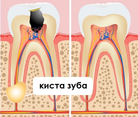 Киста на корне зуба — удалять или лечить?