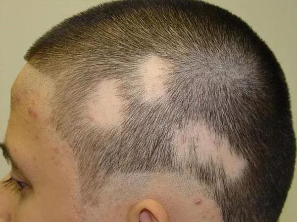 Андрогенная алопеция у мужчин и женщин: возможно ли излечение?