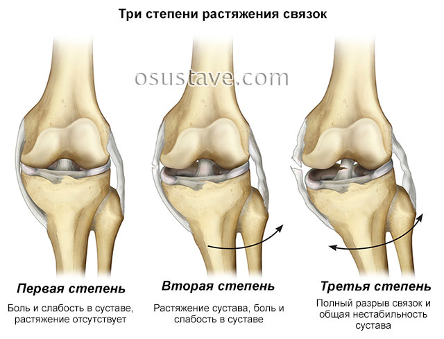 Растяжение связок коленного сустава сроки восстановления