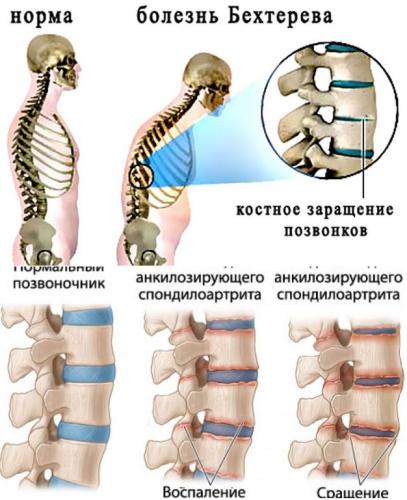 Позвоночный спондилит