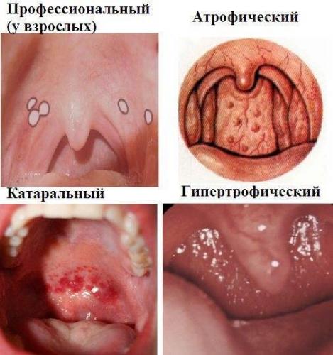 Методы восстановления пропавшего голоса при ларингите