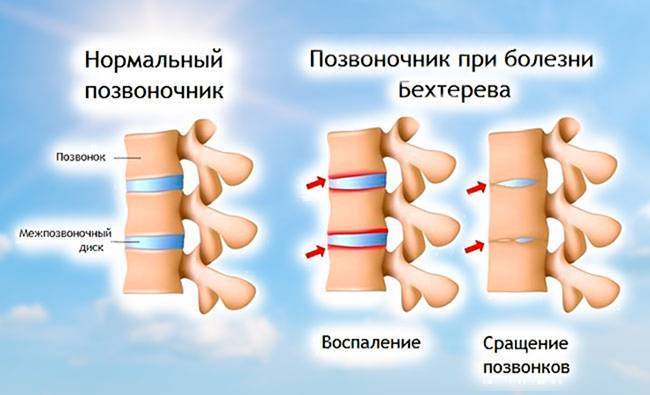 Кашель две недели и спина болит