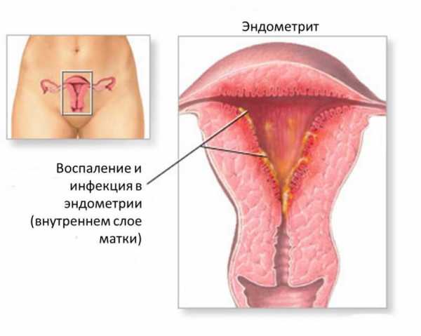Микоплазменная инфекция дыхательных путей у детей. признаки и лечение