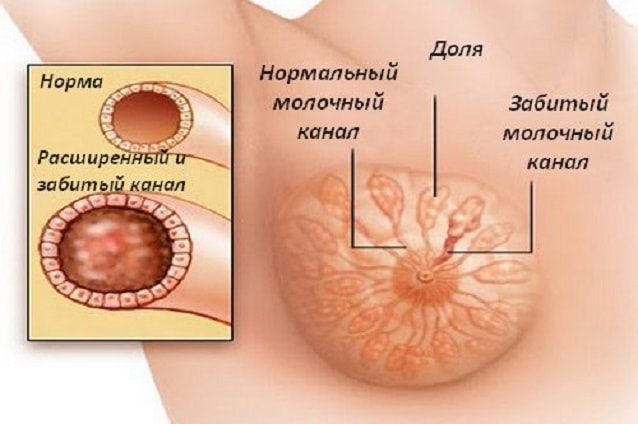 Как расцедить грудь при застое молока у кормящей мамы в домашних условиях при лактостазе