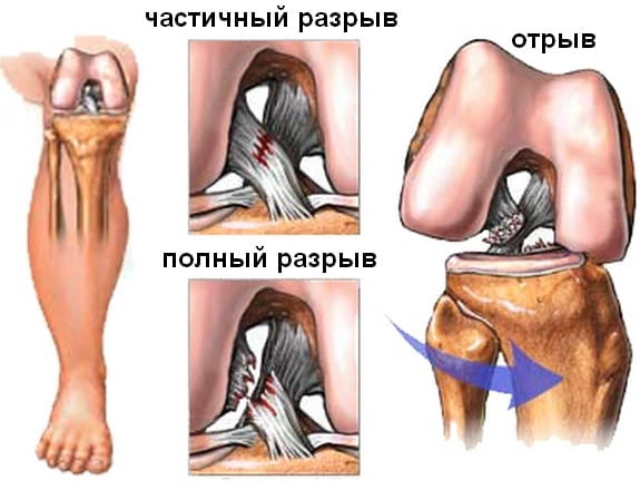 Симптомы и лечение разрыва связок коленного сустава (консервативное, операция)