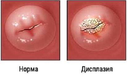 Болезни шейки матки