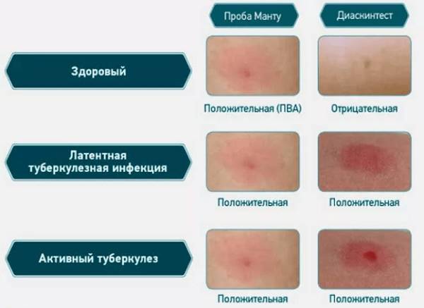 Как измерить манту в домашних условиях правильно